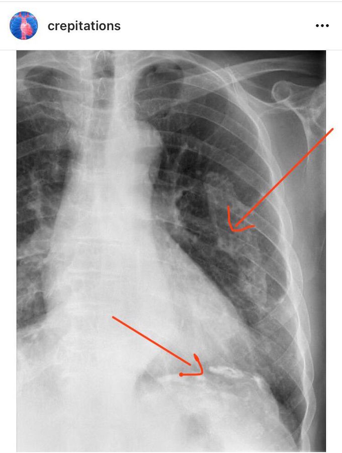 does emphysema show up on xrays