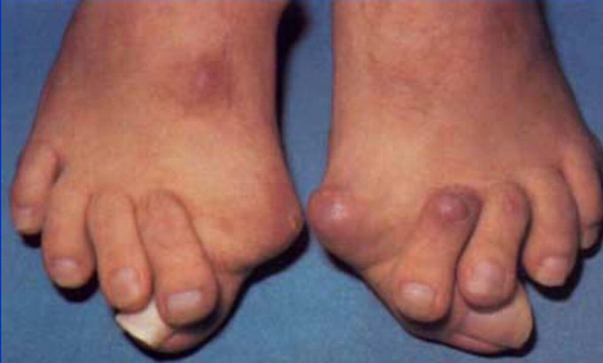 In which disease We see this shape of foot??