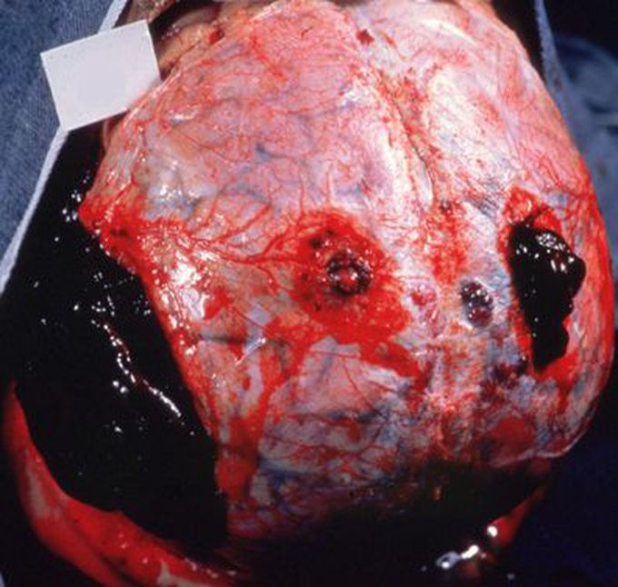 Traumatic brain injury