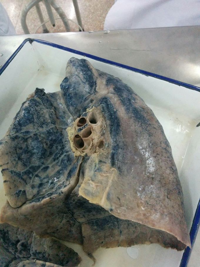 Dead person's lungs