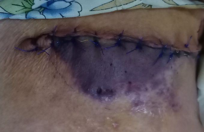 Epidermolysis