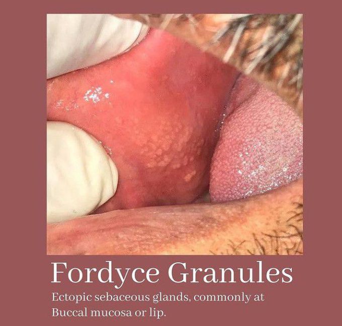 Fordyce Granules