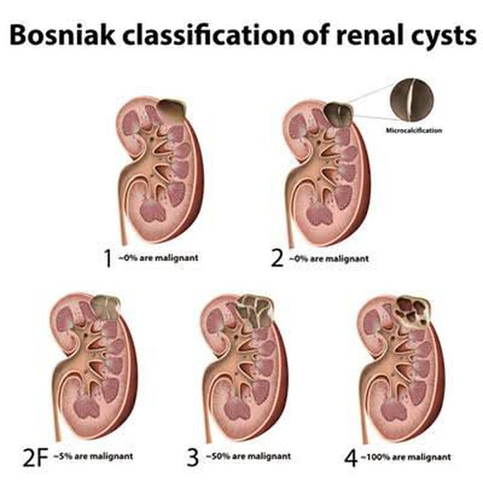 Bosniak Classification of Renal Cyst