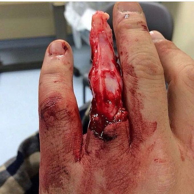 Reason not to get married: ring avulsion!! 