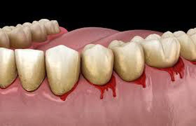 causes of bleeding gums