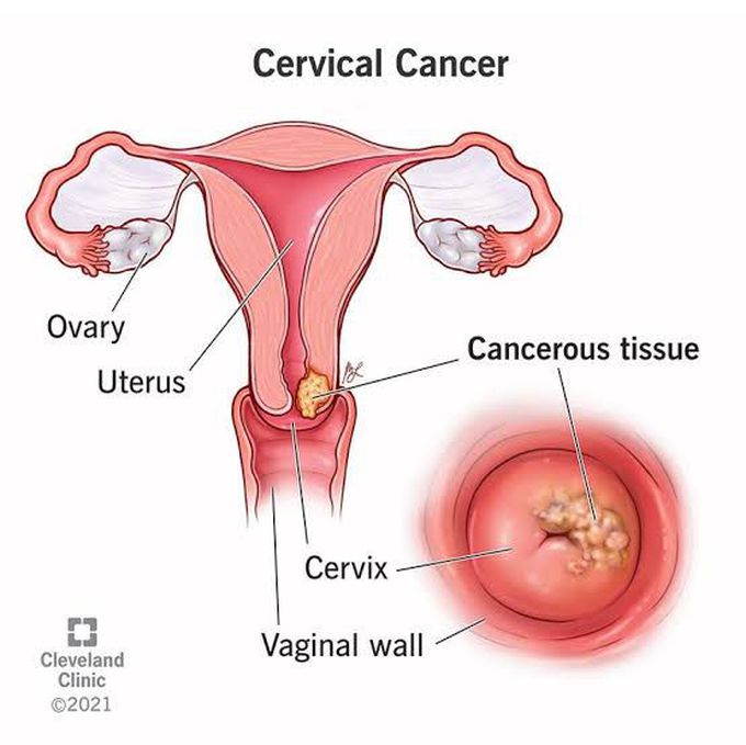 Symptoms of vaginal cancer