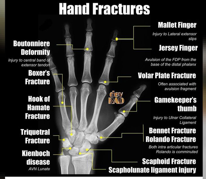 Hand Fractures