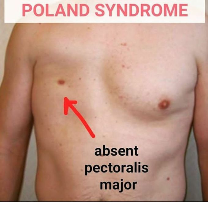 POLAND SYNDROME :