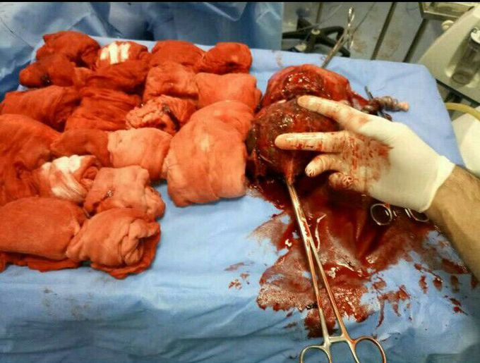 Internal hemorrhaging in a 34 week pregnant woman - management?  