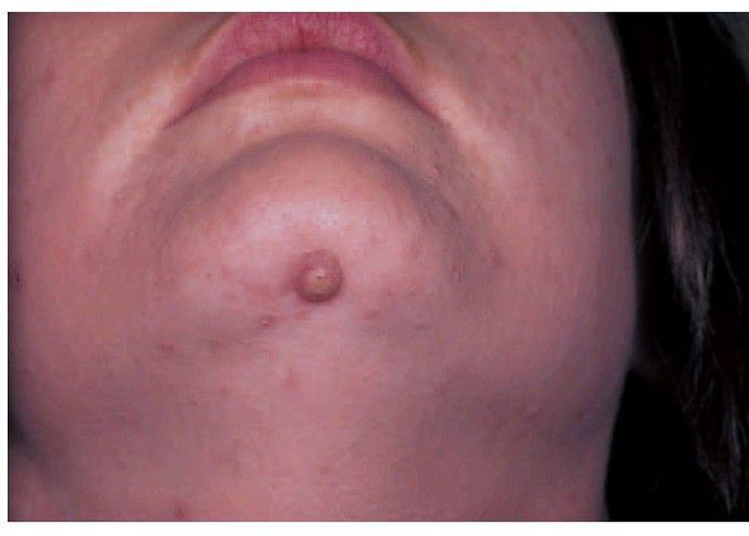 Overlooked tooth trouble