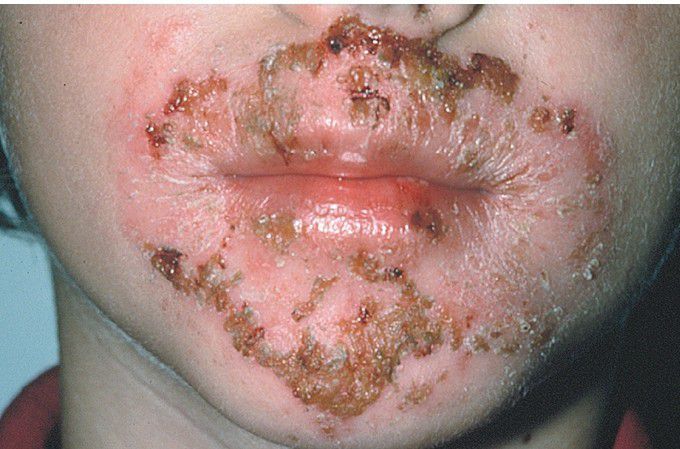 Impetigo