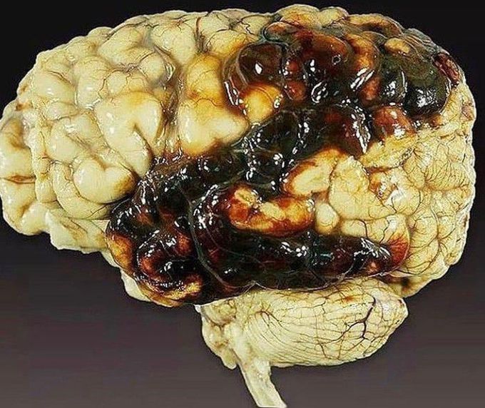  Intracranial hemorrhage (ICH)