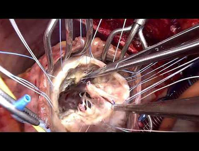 Tailored Repair of Severe Tricuspid Regurgitation Due to Pacemaker Lead