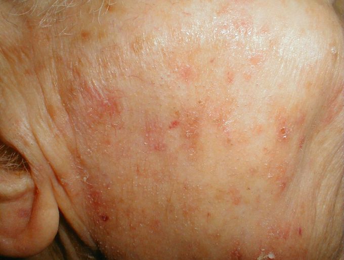 Actinic keratosis

It is most common on the face, lips, ears, back of hands, forearms, scalp, and neck. The rough, scaly skin patch enlarges slowly and usually causes no other signs or symptoms. A lesion may take years to develop.