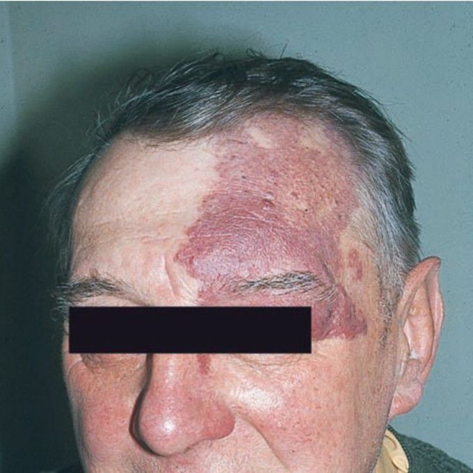 Sturge weber syndrome