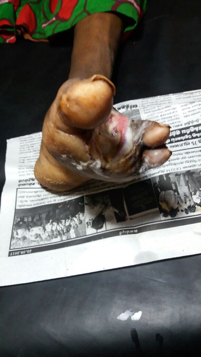 Diabetic wound,