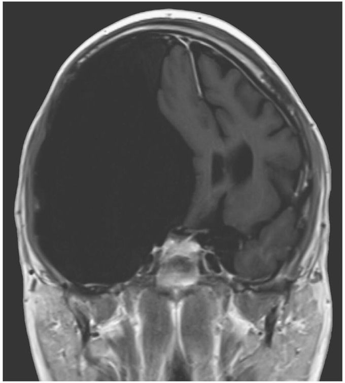 Magnetic resonance imaging of the brain revealed an arachnoid cyst
