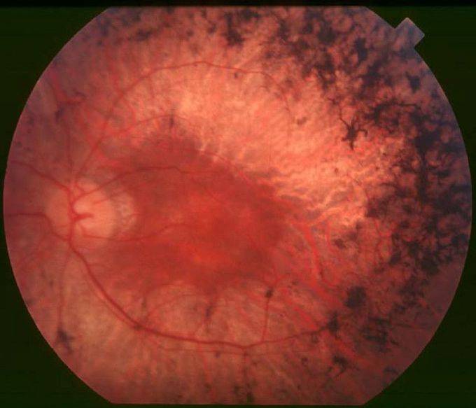 RETINITIS PIGMENTOSA (RP)