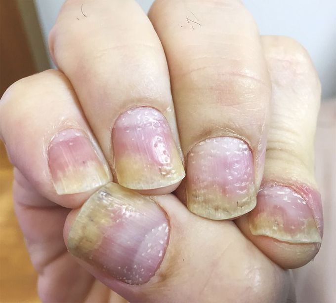 Nail Pitting in Psoriasis