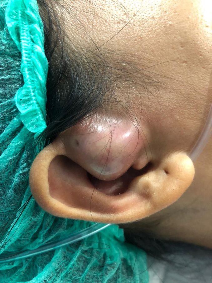 Abscess fistula of auricula