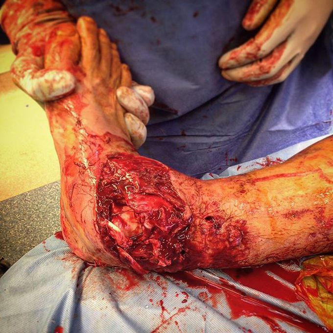 Motor vehicle trauma!!