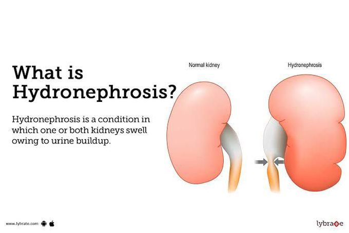 Hydronephrosis