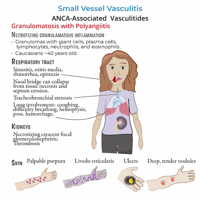 Granulomatosis With Polyangiitis