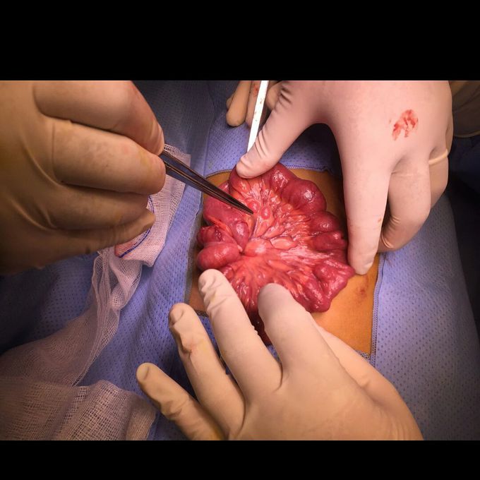 Mesenteric lymphadenitis