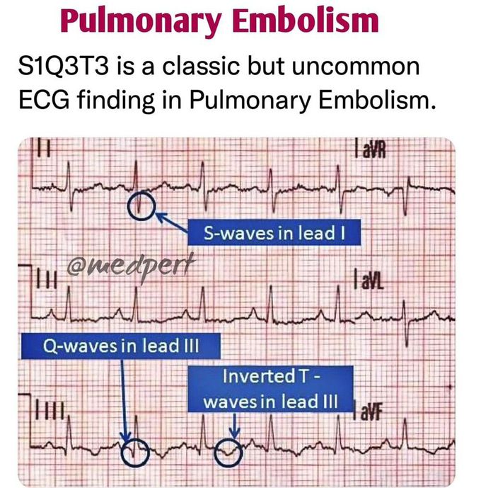 Pulmonary Embolism