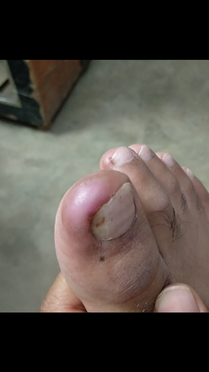 In-grown toenail
