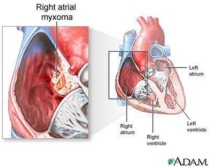Cardiac myxoma