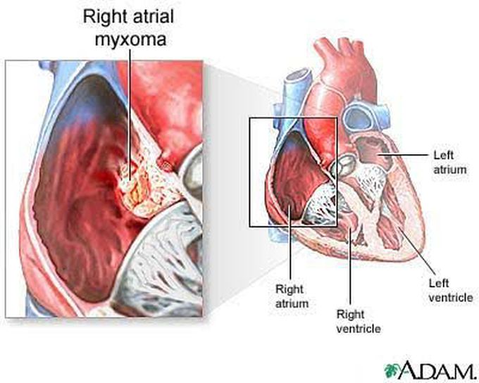 Образование левого предсердия. Опухоль сердца миксома. Доброкачественная опухоль сердца миксома. Объемные образования сердца. Опухоли левого предсердия.