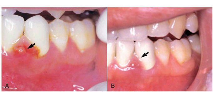 acute endodontic pathosis