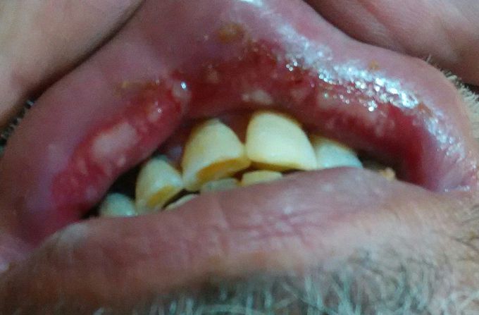 Oral diseases