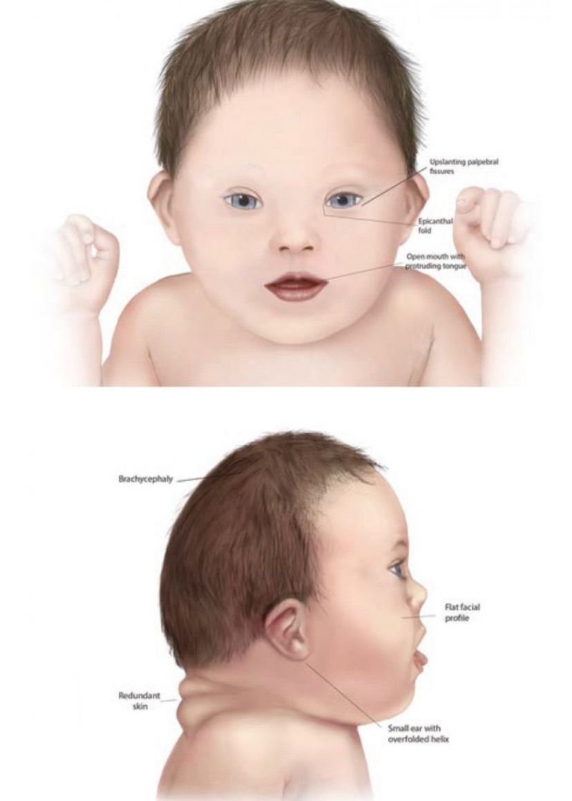 Форма головы у детей с синдромом Дауна