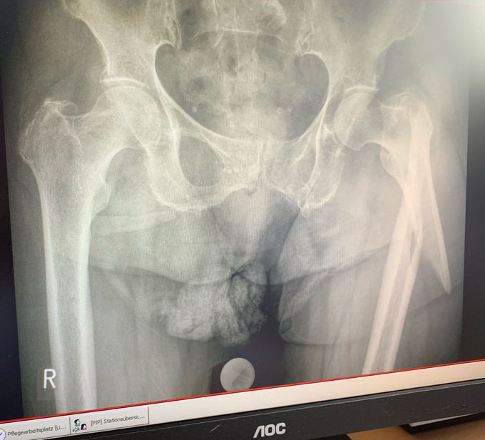 Fracture femuralis