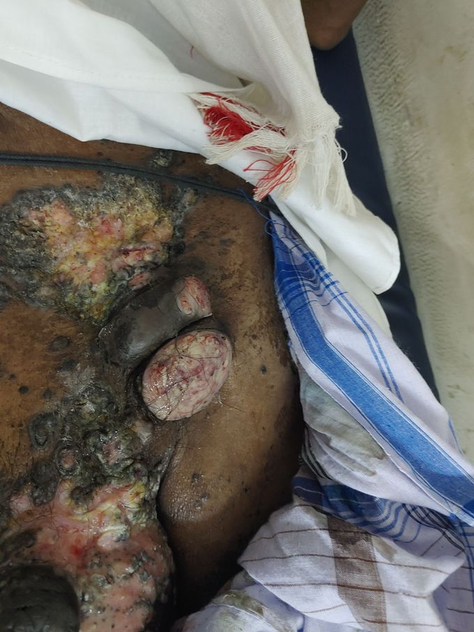 A person of age 60 male came to hospital complaining i have severe pain prescribe some medicines doctor told its necrosis you have to undergone a surgery otherwise its infects more its a skin cancer