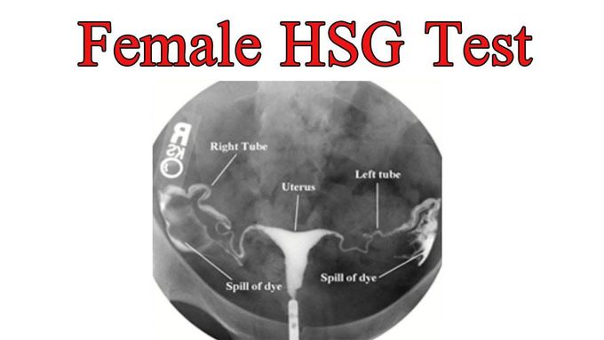 Normal HSG