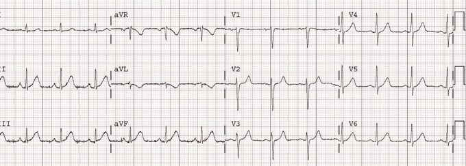 Cardiovascular Diseases