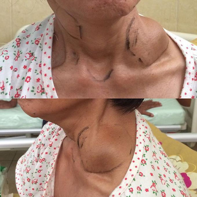 Neck tumor suspect metastasis from hypopharing carcinoma 