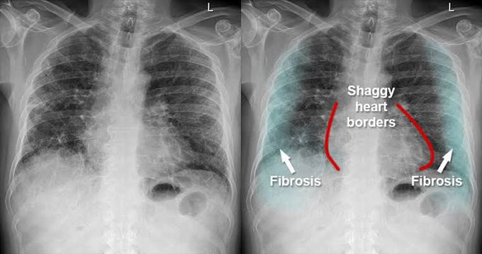 Pulmonary fibrosis