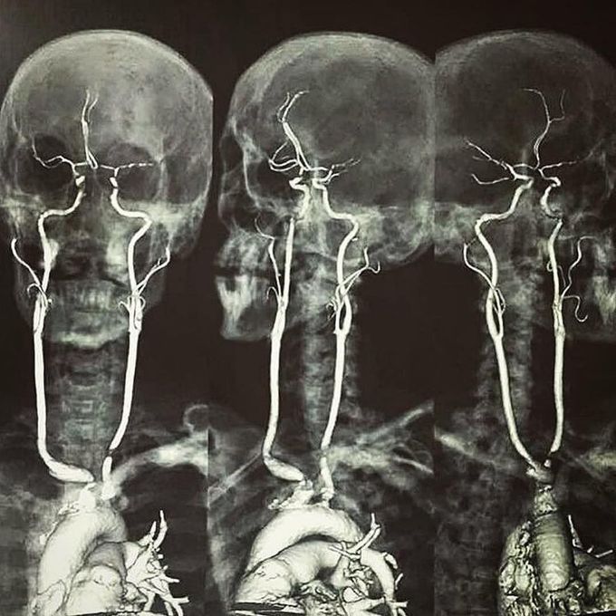 carotid arteries!!