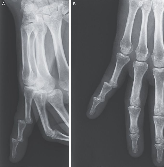 Stepladder Dislocation of the Finger