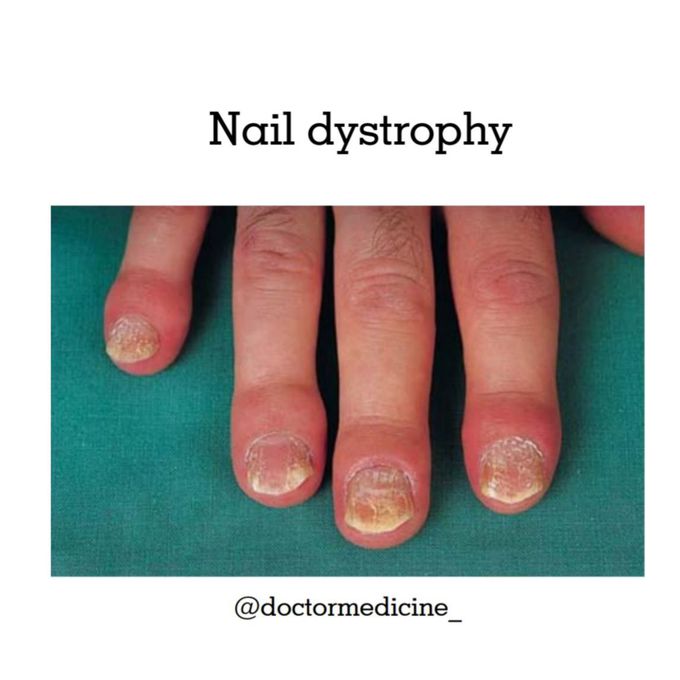 Nail dystrophy