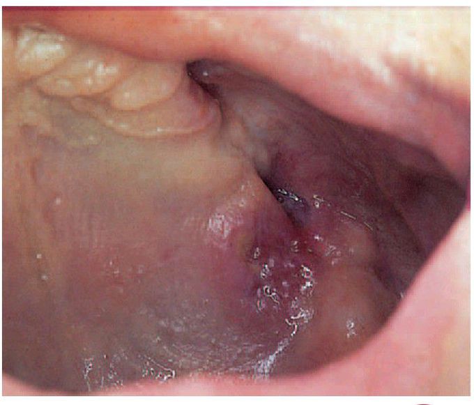 Langerhans cell histiocytosis.