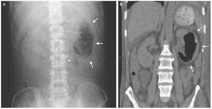 Emphysematous Pyelonephritis