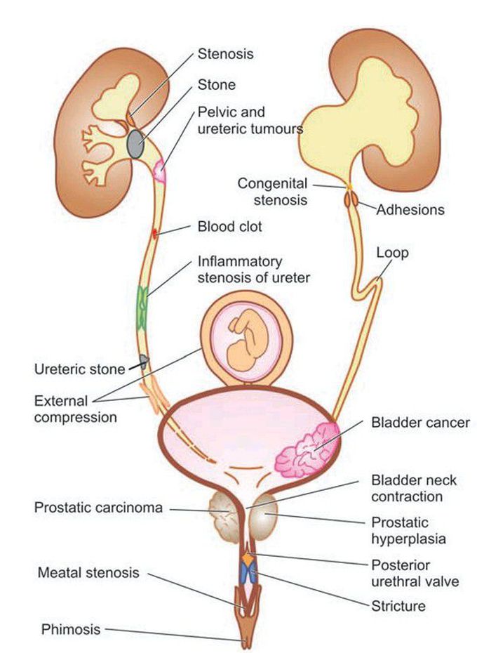 Obstructive uropathy