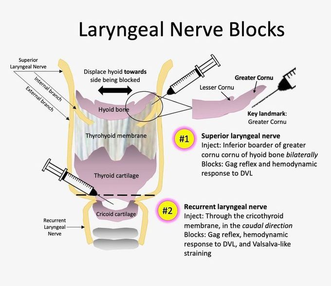 Laryngeal Nerve Block