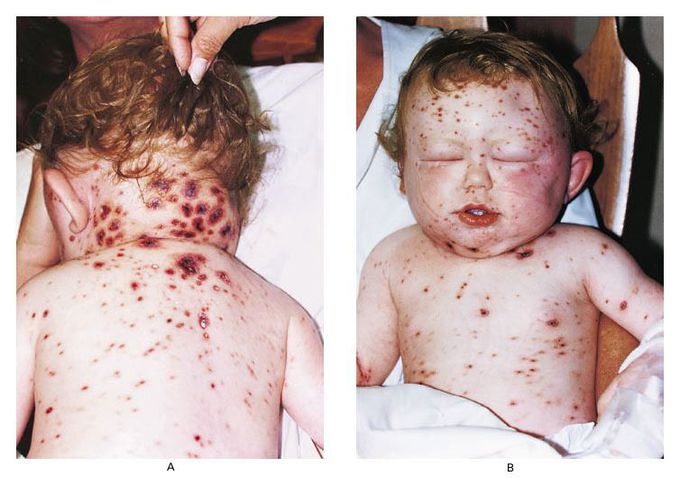 Varicella Gangrenosa