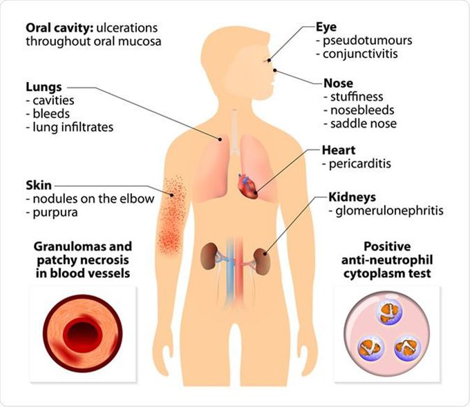 Granulomatosis symptoms